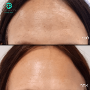 בוטוקס במצח - לפני אחרי