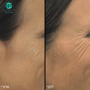 בוטוקס סביב עיניים - לפני אחרי