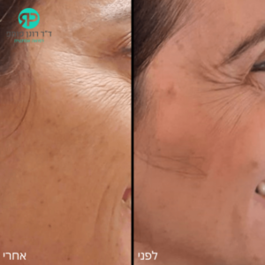 בוטוקס סביב עיניים - לפני אחרי
