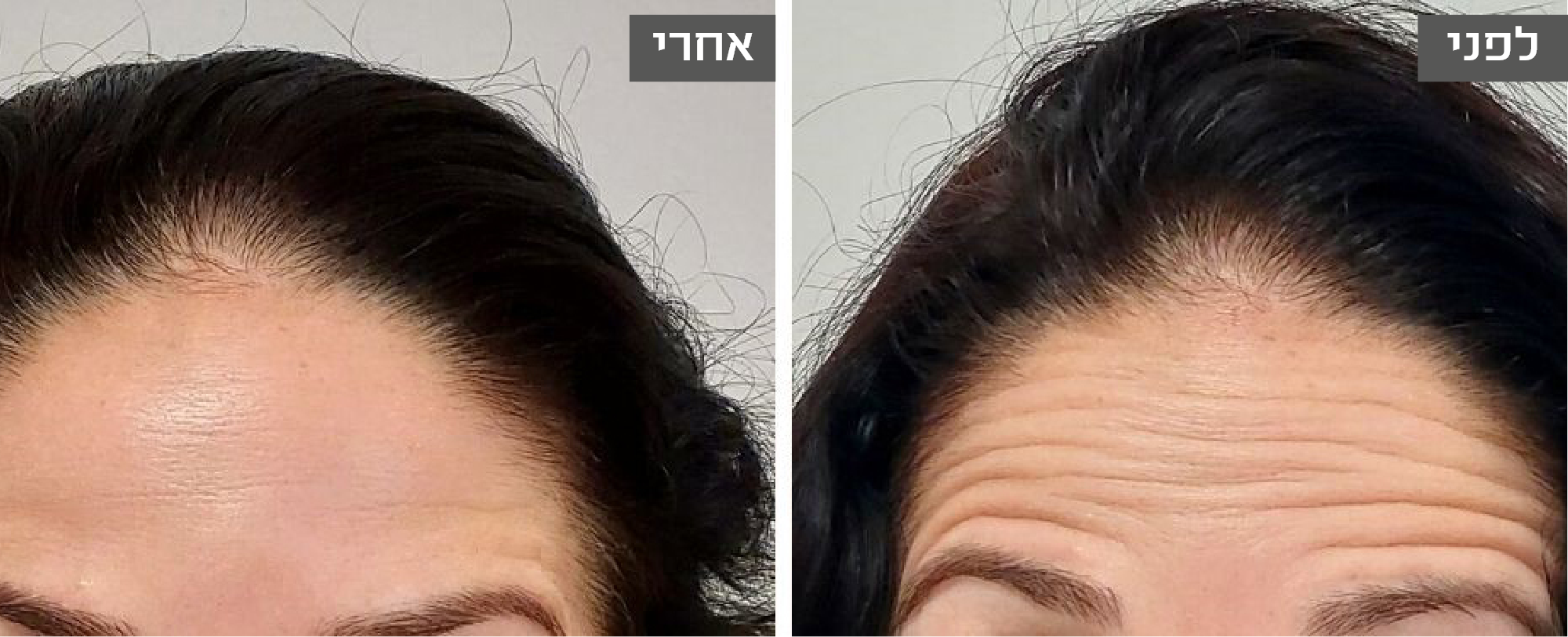 בוטוקס במצח - לפני ואחרי