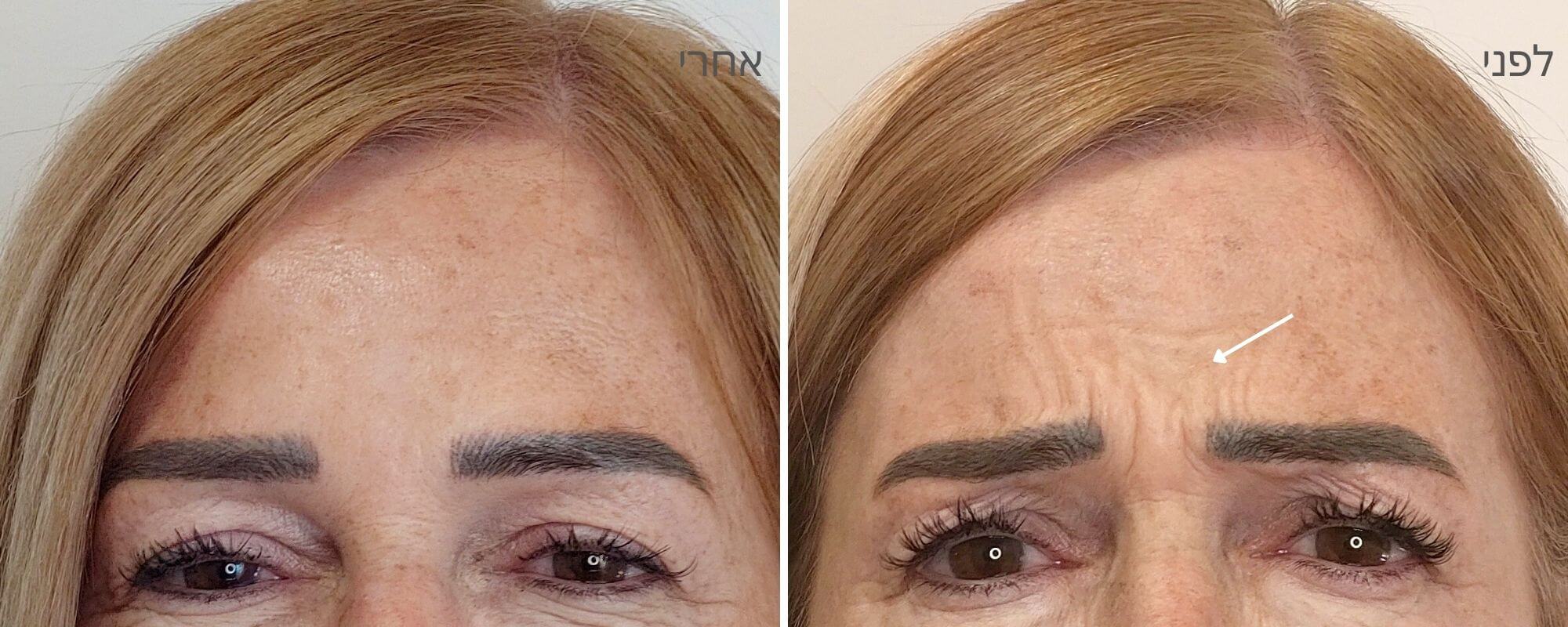 בוטוקס בין הגבות - לפני ואחרי