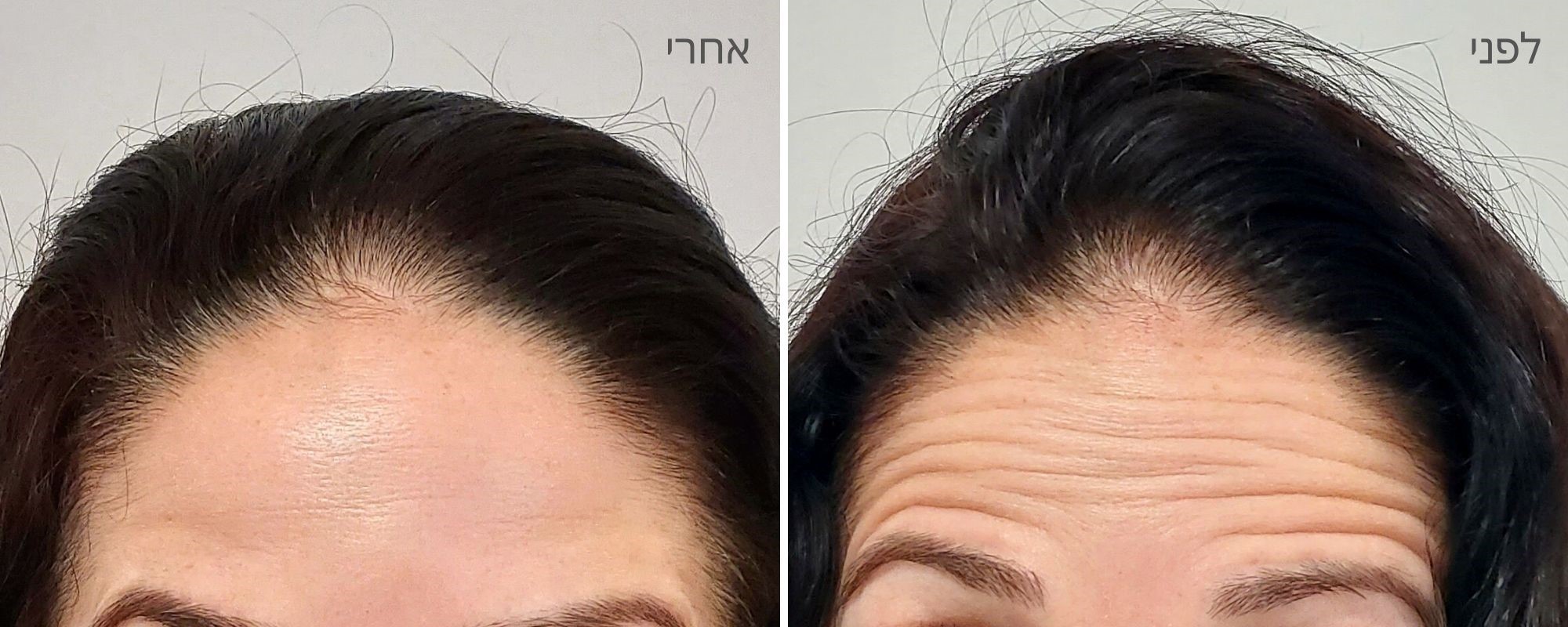 בוטוקס במצח - לפני ואחרי
