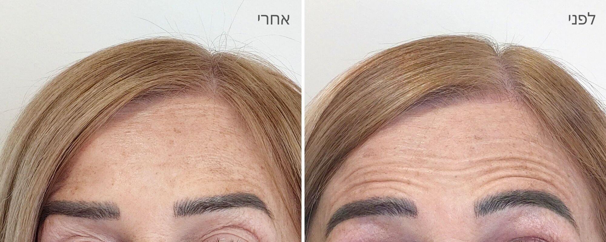 בוטוקס במצח - לפני ואחרי