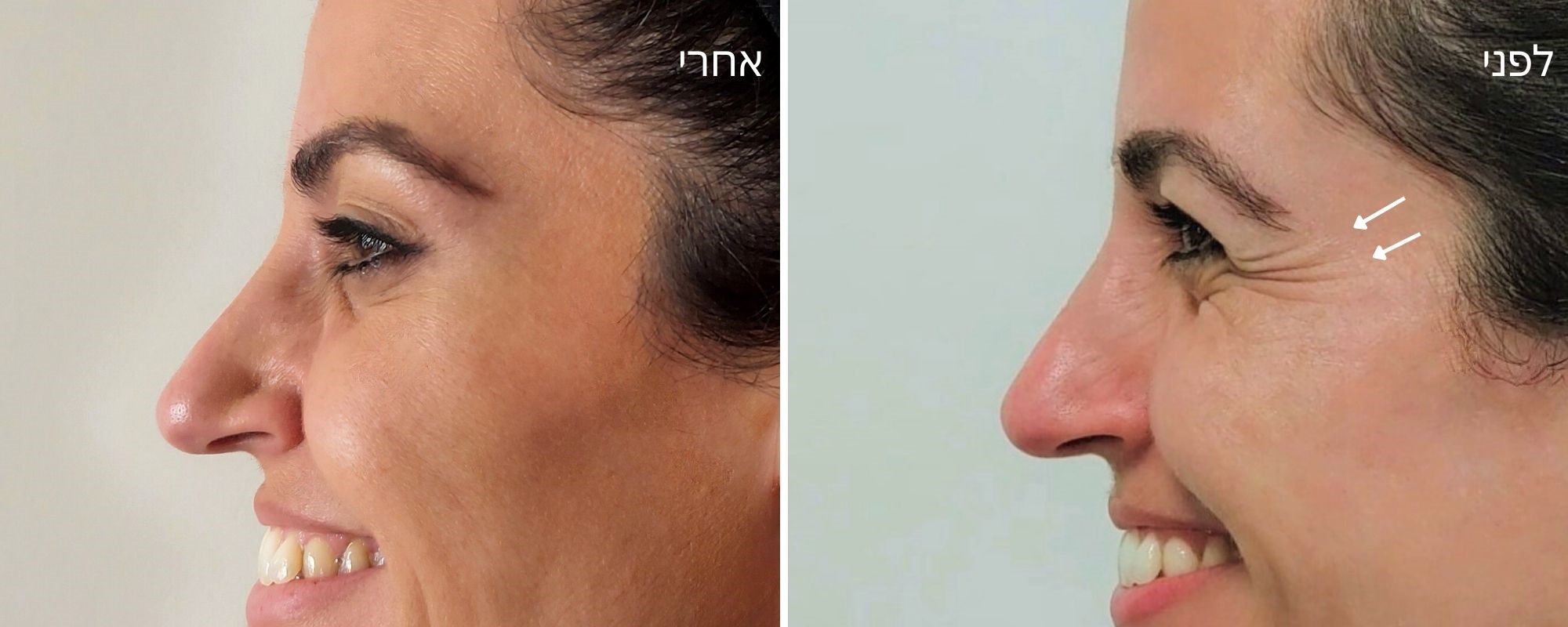 בוטוקס בצידי עיניים - לפני אחרי
